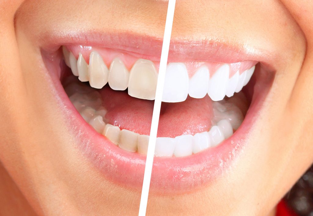 laser teeth whitening glasgow before and after