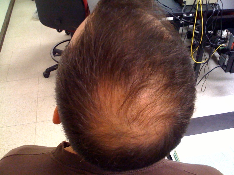 Balding? Stop Fighting It And Shave It All Off!